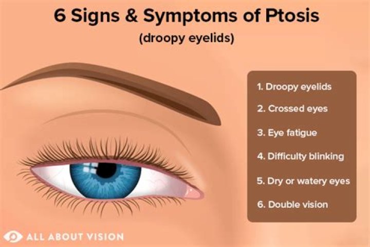A Deeper Look Into Ptosis