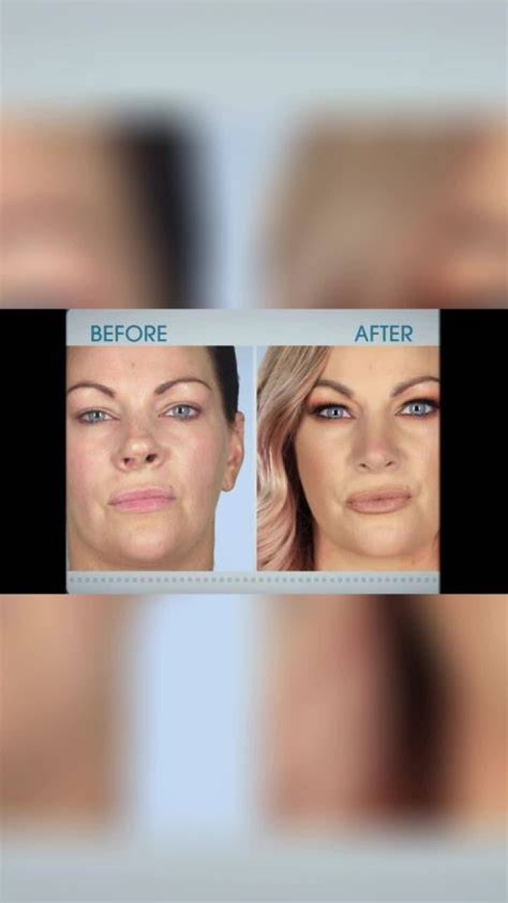 Before And After Cosmetic Enhancements