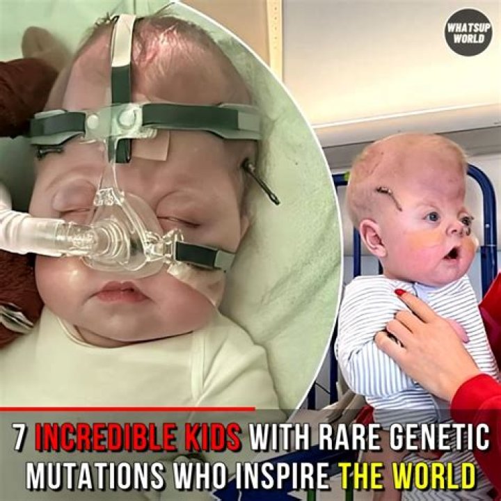 Boy has world's rarest genetic condition ·