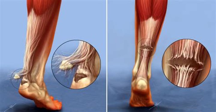 Can You Self-Heal A Torn Tendon?