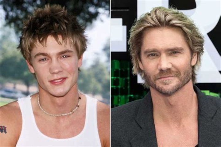 Chad Michael Murray's Surgery: Before And After