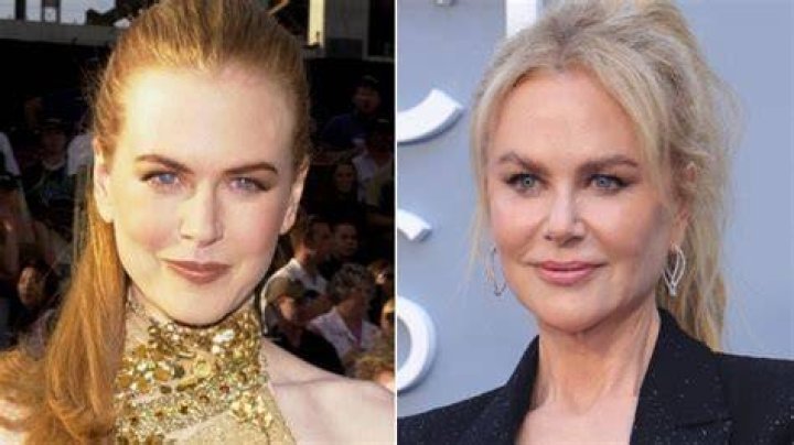 Discover Nicole Kidman's Surgery Journey: Before And After