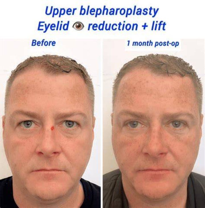 Discover The Secrets Of Celebrity Hooded Eye Surgery