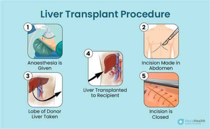 Expert Liver Transplants By Surgeons In Texas