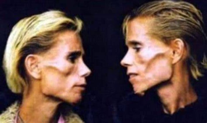 Famous anorexic identical twins die in house fire following prophecy they would die together ·