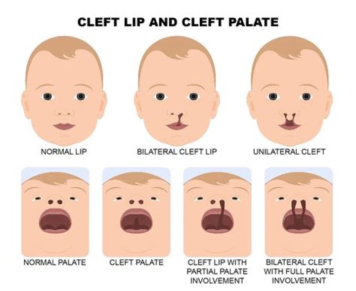 Famous Faces With Cleft Lip And Palate: Courageous Celebrities