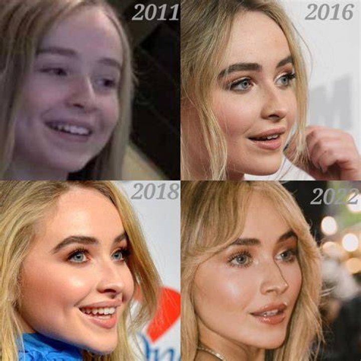 Sabrina Carpenter Reveals Lip Filler Transformation: Before And After Photos
