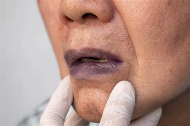 Skin discoloration - bluish ·