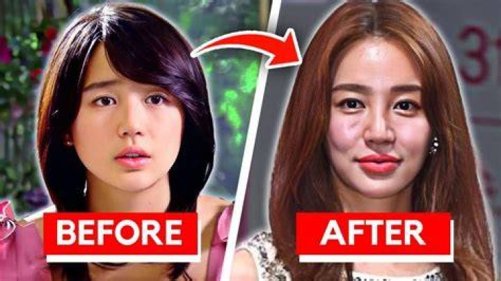 Song Kang's Appealing Transformation: A Journey From Before To After Surgery
