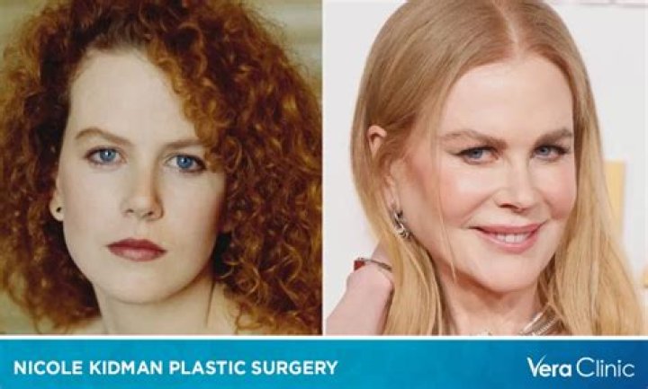 The Ultimate Guide To Nicole Kidman's Plastic Surgery: Insights And Analysis