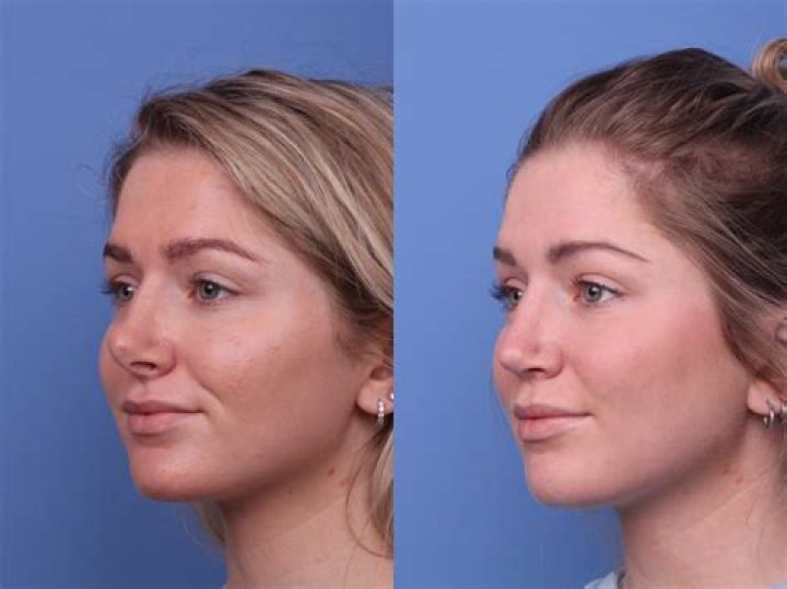 The Ultimate Guide To Zach Braff's Plastic Surgery: Before And After Photos