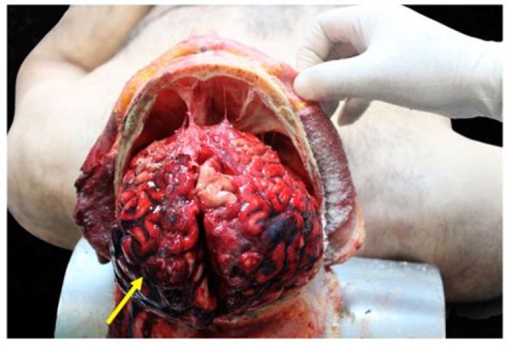 The Unbelievable Autopsy Findings Of Tarrare: A Case Of Extreme Hunger