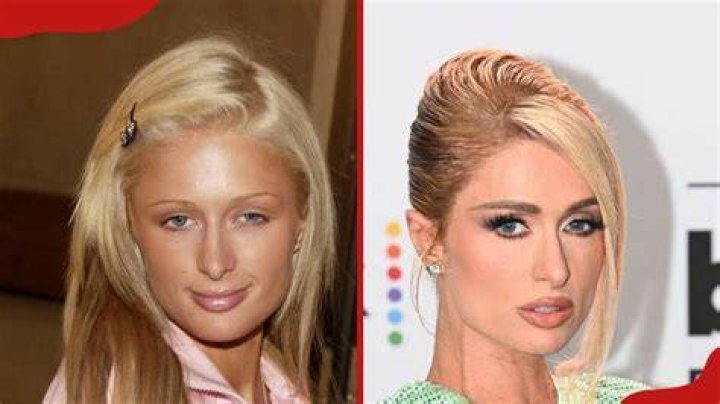 Unveiling The Secrets Of Paris Hilton's Plastic Surgery Journey: Discoveries And Insights