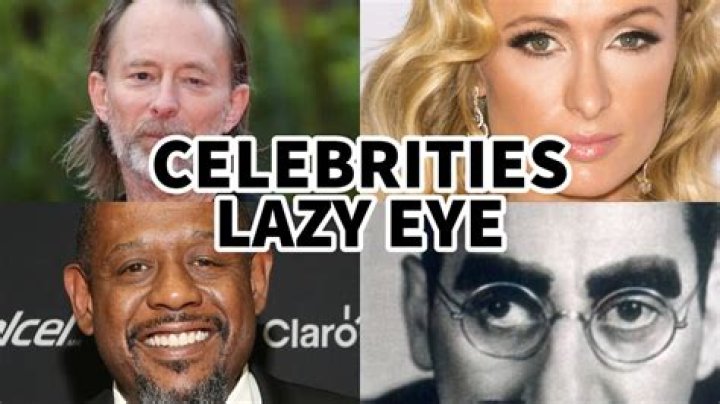 Unveiling The Secrets: The Journey Of Actors With Lazy Eye