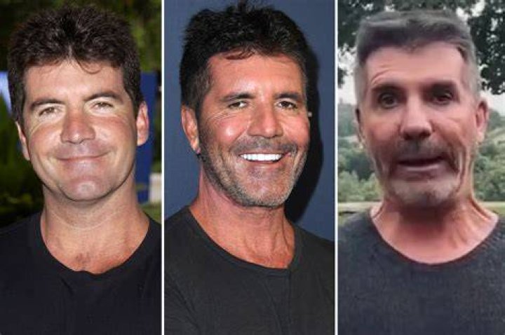 What You Need To Know About Simon Cowell's Eye Surgery
